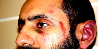 Injury photograph of Babar Ahmad, 2 Dec 2003, taken at Charing Cross police station, London