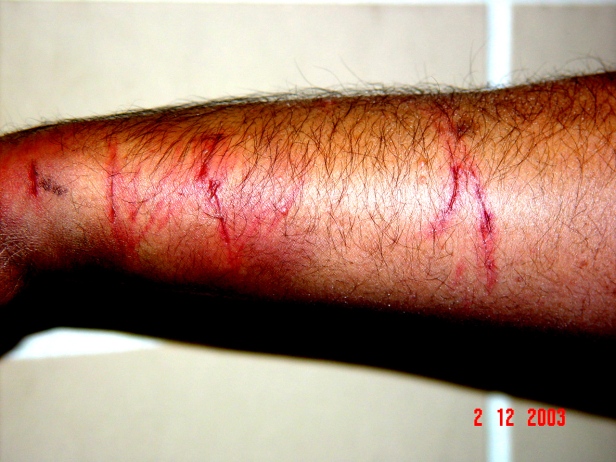 Injuries sustained to my right forearm after a police officer tortured me in 2003
